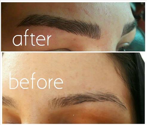 میکروپگمنتیشن پریا میکروپگمنتیشن پریا