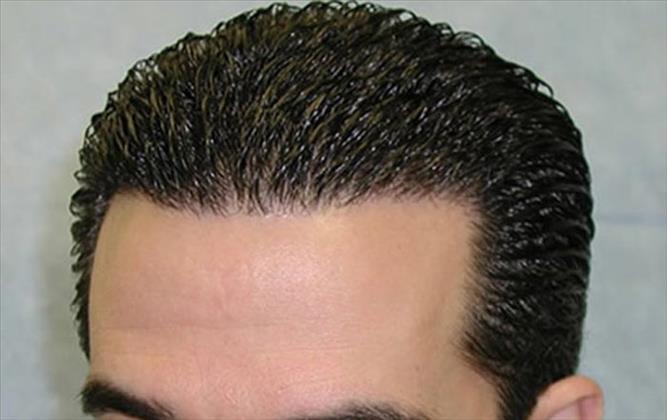 متخصص کاشت مو