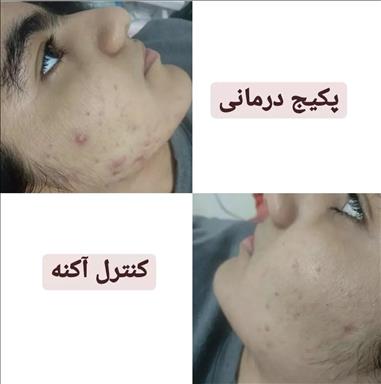 پنجه ی آقتاب در بندر انزلی
