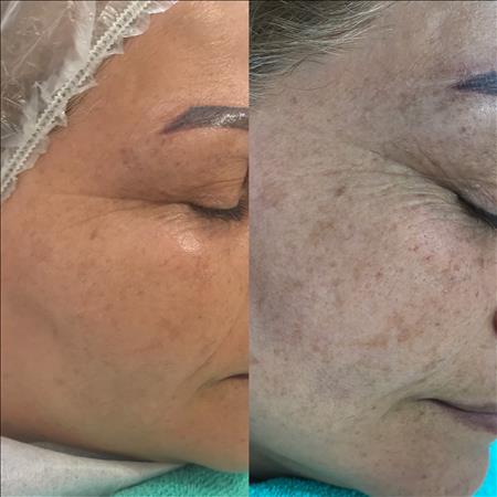 آموزش پاکسازی پوست اندواری