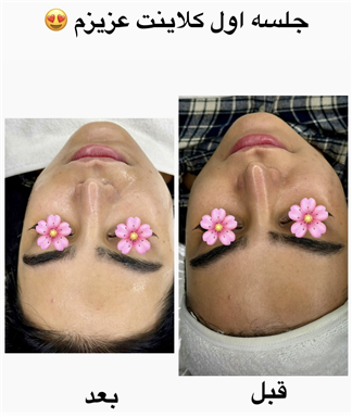 پاکسازی و فیشال حسنا 1