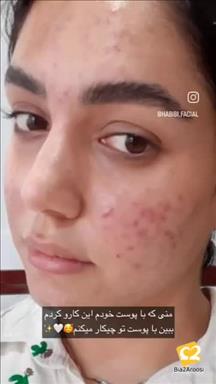 پاکسازی و فیشال فاطمه حبیبی 11